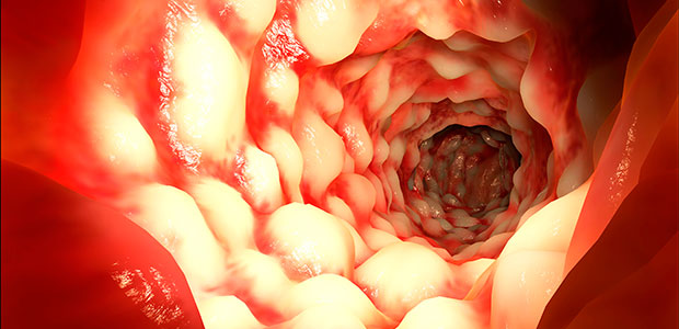 Irritable Bowel Syndrome