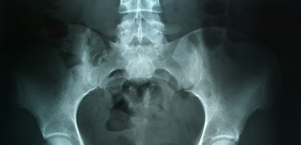 Prevention Today = Healthy Bones Tomorrow